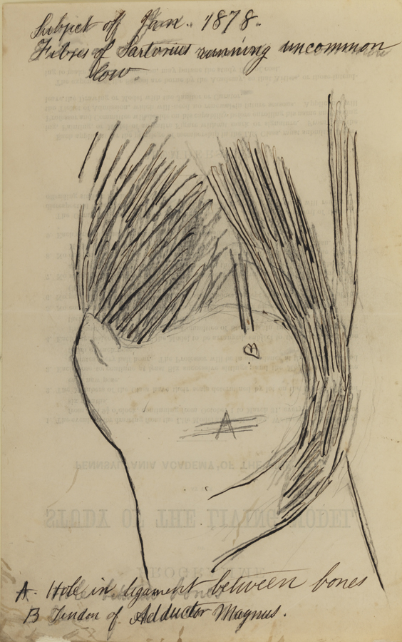 Dissection Study: Human (Fibres of Sartorius Running Uncommon(ly) Low)